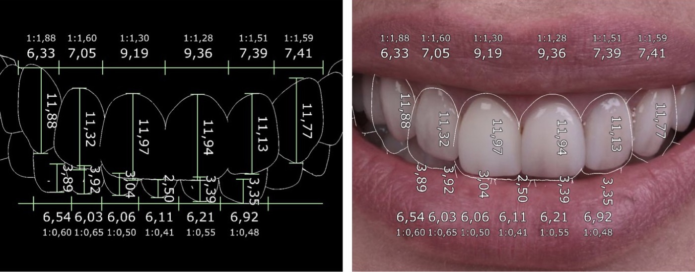 Medidas dos dentes em milímetros